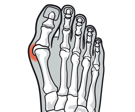 bunion hallux valgus